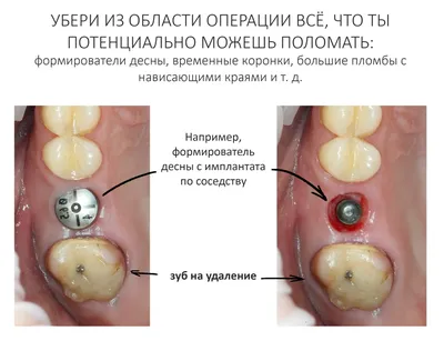 помогите... удалили зуб.. в дырке после него какая-то белая хрень | Дневник  пользователя Ryu | Брекет.Info