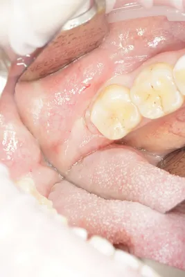 Гемостатическая губка в лунке зуба - Вопрос стоматологу - 03 Онлайн