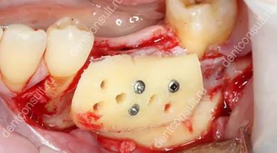 Что стоматолог кладет в лунку после удаления зуба | Рустем Галиуллин | Дзен