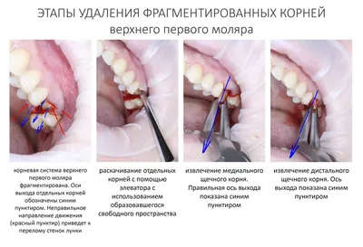 Гемостатическая губка в стоматологии - Много зубов