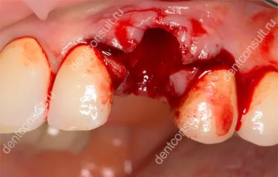 Осложнения после удаления зуба: в лунке что-то белое, кровоточит рана,  болит десна, на десне образовался нарост, опухла щека – Стоматология в  Бирюлево