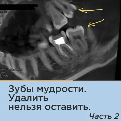 Что стоматолог кладет в лунку после удаления зуба | Рустем Галиуллин | Дзен