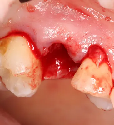 Простое удаление зуба за 10 шагов. — IMPLANT-IN.COM — дентальная  имплантация. естественно.