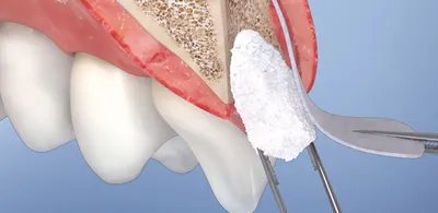 Что стоматолог кладет в лунку после удаления зуба | Рустем Галиуллин | Дзен