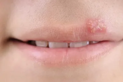 Герпес на губе после орально-генитального контакта: причины, симптомы и  лечение