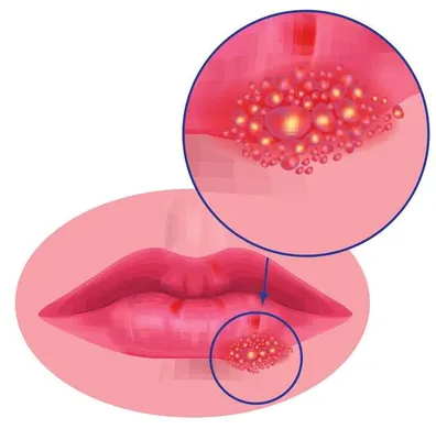 Герпес на губе после орально-генитального контакта: причины, симптомы и  лечение