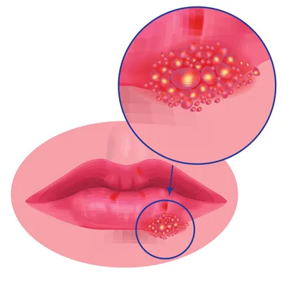 Герпес на губе: симптомы, лечение, диагностика | Major Clinic