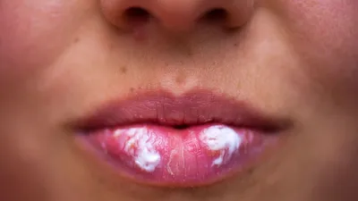 Как лечить герпес на губах — Актуальная тема — tsn.ua