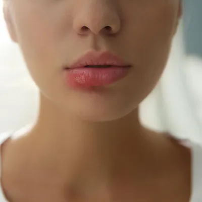 Герпес на губах (простуда): чем лечить, причины, симптомы и как быстро  избавиться