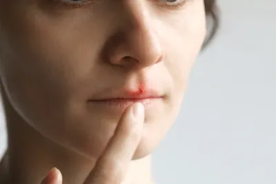 Герпес на губах: что это, причины, симптомы, лечение | РБК Стиль