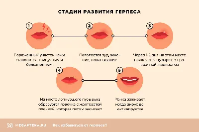 Как вывести герпес из организма навсегда. Быстрое лечение герпеса |  Мегаптека.ру