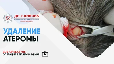 Плоскоклеточный рак верхней челюсти с ороговением у кошки во рту: лечение