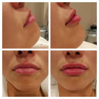 Увлажнение губ гиалуроновой кислотой без увеличения - клиника лазерной  косметологии в Москве