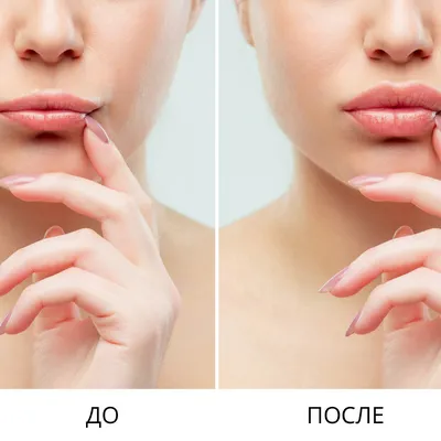 Контурная пластика коррекция и увеличение губ гиалуроновой кислотой цена  услуги в Москве | Клиника Нео Вита