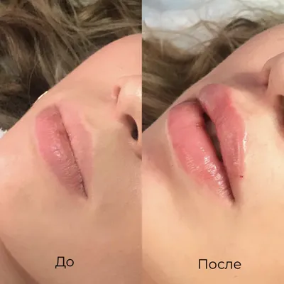 Увеличение губ фото до и после коррекции | Клиника Гришкяна