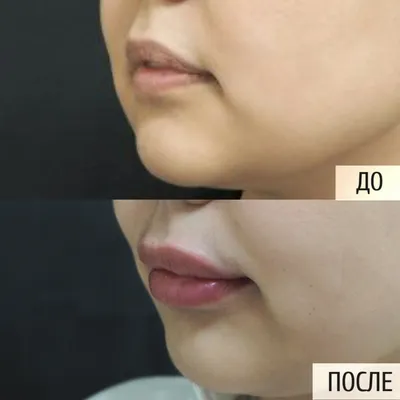Увеличение губ в Москве: цены, фото до и после, отзывы | Стоимость увеличения  губ в клинике Seline