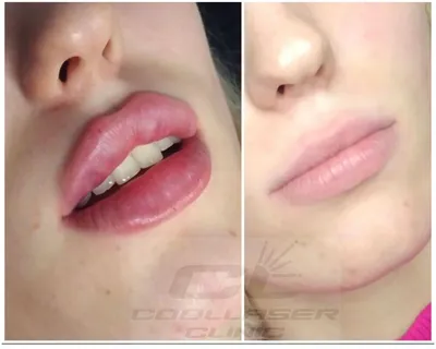 Ошибки контурной пластики губ и как их исправить — JES Cosmetology