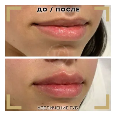 Увеличение и коррекция губ гиалуроновой кислотой в Москве цена, отзывы,  фото - Косметология доктора Корчагиной