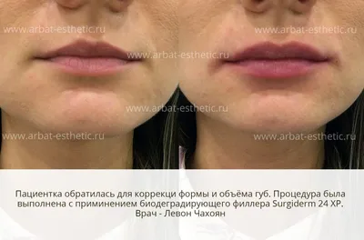 Отек губ после увеличения (аугментации) гиалуроновой кислотой | Клиника  \"Отражение\"