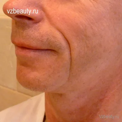 Заполнение носогубных складок у мужчин — vzbeauty.ru
