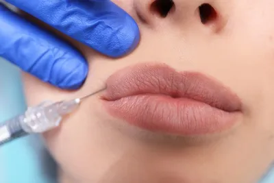Увеличение губ гиалуроновой кислотой в Москве, цены в клинике Vitaura