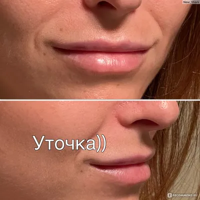 Ботокс для лица или гиалуроновая кислота ✔️ Блог клиники ЛИЦА