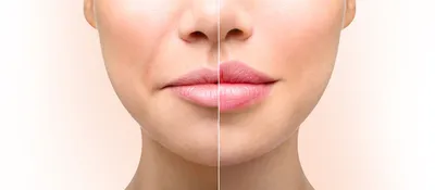 Гиалуроновая кислота Juvederm Ultra 3 - «Фото-дневник первого увеличения  губ: ощущения и результаты по дням! Стоит ли оно того? Ассиметрия губ. Фото  ДО, ПОСЛЕ, спустя 5 месяцев.» | отзывы