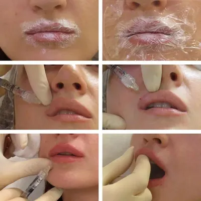 Royal Estetic - 👄 Коppекция формы и размеров губ👄 Гиалуроновая кислота -  основной компонент межклеточного вещества 👌Сопутствующими результатами  является омоложение и увлажнение дермы в этой области. Применение гиалуроновой  кислоты для увеличения губ ...