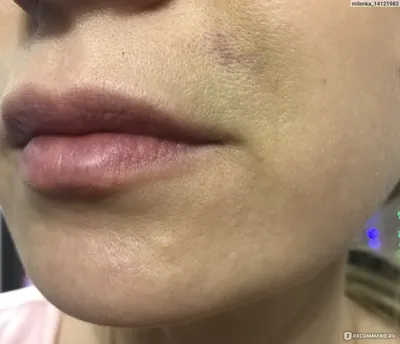 Инъекции в губы гиалуроновой кислоты👄👄👄 Инъекции гиалуроновой кислоты в  губы — самая востребованная и популярная процедура. С помощью уколов  красоты косметолог возвращает коже молодость, а губам привлекательный вид.  Процедура увеличения губ позволяет