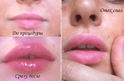 Укол гиалуроновой кислоты в губы - \"MSS - сеть клиник косметологии\"