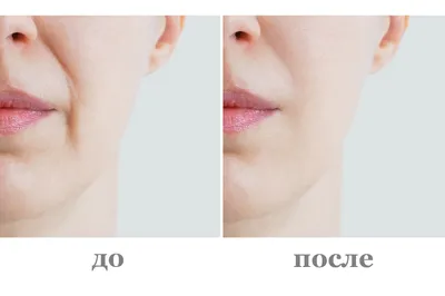 Как снять отек после увеличения губ гиалуроновой кислотой - блог Cleo Line