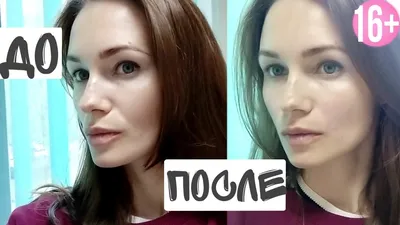 Носогубные складки: почему появляются, способы уменьшения и удаления  носогубки в домашних условиях и у косметолога