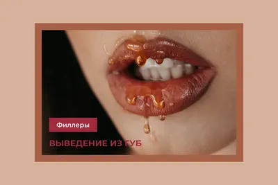 LETE институт красоты - Контурная пластика носогубных складок – методика  заполнения носогубных складок изнутри с помощью филлеров на основе гиалуроновой  кислоты. Филлеры хорошо приподнимают кожу, выравнивают морщины, а гиалуроновая  кислота омолаживает и