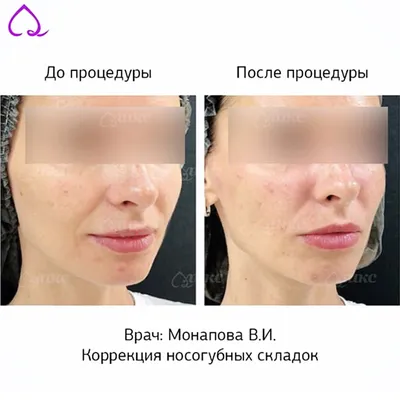 Коррекция носогубных складок цены - Клиника косметологии ЛИКС