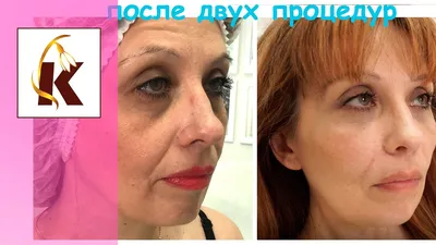 Удаление филлера из губ - выведение гиалуроновой кислоты