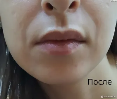 Контурная пластика губ цена - Салон Косметологии м.Академическая  8(903)1790858