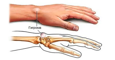 Гигрома — лечение в Ростове-на-Дону | Цены и отзывы