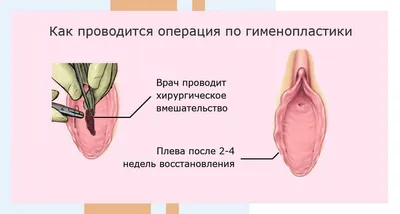 Гименопластика в Москве - цена операции по восстановлению девственности в  клинике АльтраВита