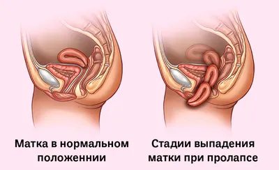 Восстановление девственной плевы (гименопластика) клиника в Москве ЮЗАО