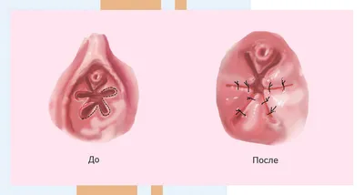 Гименопластика в Москве - цена операции по восстановлению девственности в  клинике АльтраВита