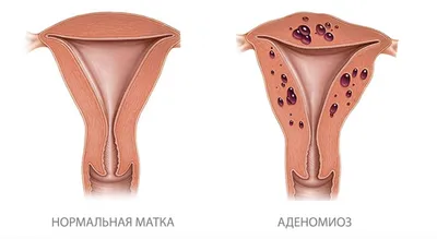 Удаление гигром лазером в Москве 🎀 | Цены от 10 000 в клинике «Dekamedical»