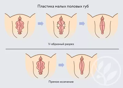 Реконструкция, операция по подтяжке груди в СПб, цена | Клиника доктора  Куприна