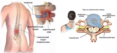 Как лечить позвоночные грыжи народными средствами? - Тренажер ПравИло
