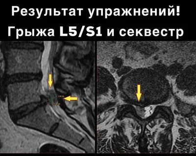 Грыжа С5–С6 шейного межпозвонкового диска, лечение, операция, симптомы