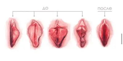 Интимная пластика влагалища после беременности и родов