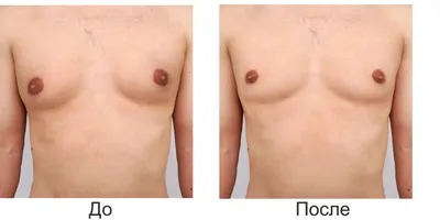 Гинекомастия