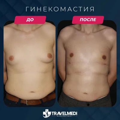 Гинекомастия - TravelMEDI