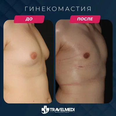 Рекомендации и ограничения в послеоперационном периоде после операции по  удалению гинекомастии