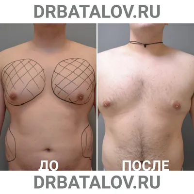 MEDAS Medical Center - Гинекомастия До и через месяц после операци |  Facebook