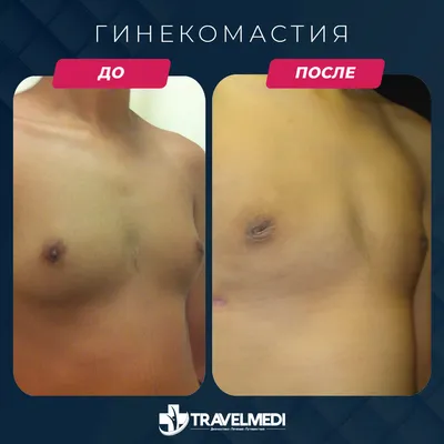 Удаление гинекомастии, уменьшение груди у мужчин в Киеве | Доктор Зыков